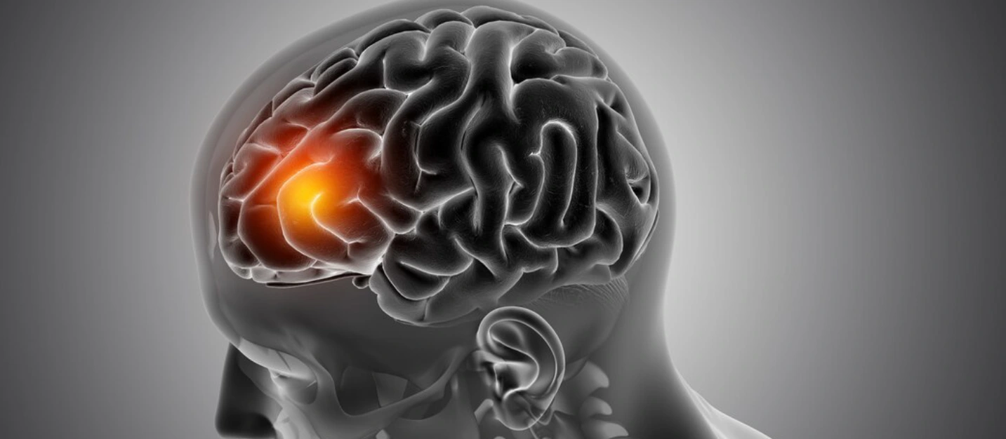 Beyin Damar Hastalıkları (Anevrizma, AVM, İnme Cerrahisi)