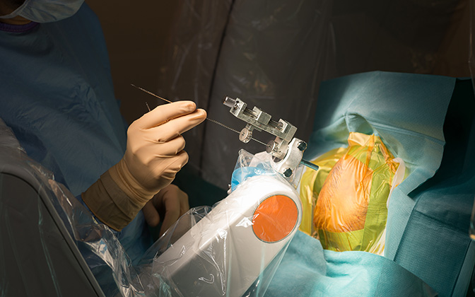 Fonksiyonel Beyin Cerrahisi