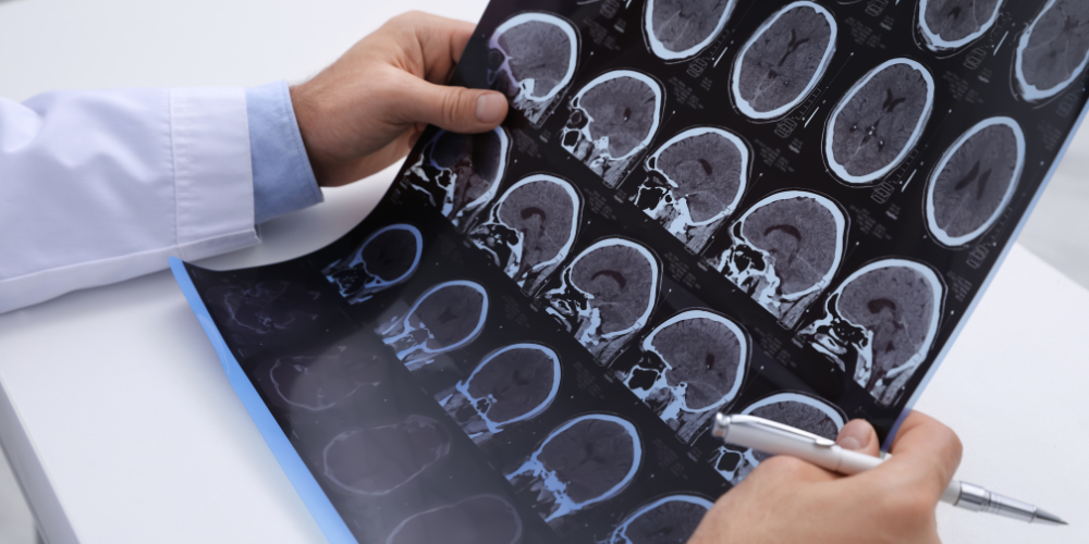 Multipl Skleroz (MS) Kök Hücre Tedavisi