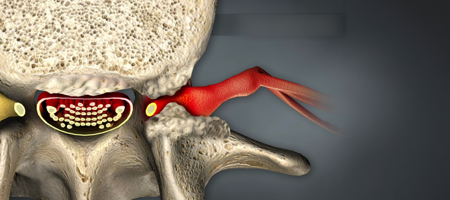 Omurilik Kanal Daralması (Spinal Stenoz) Cerrahisi