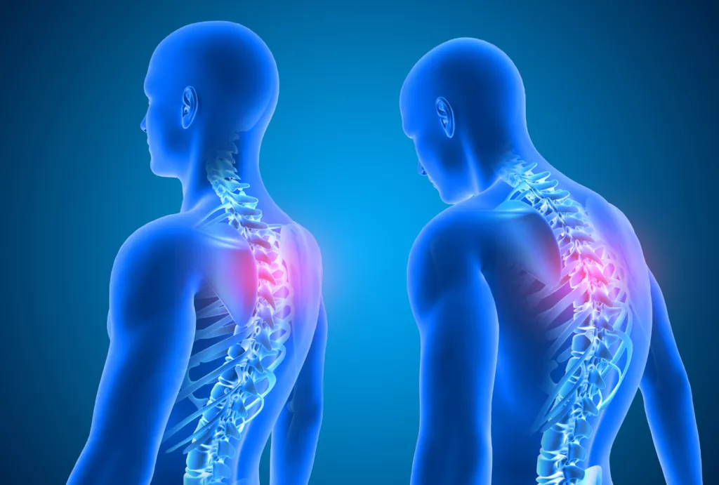 Sinir Sıkışması (Tuzak Nöropatiler)